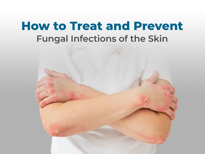Read more about the article फंगल इंफेक्शन से बचाव के तरीके Ways to Prevent Fungal Infection