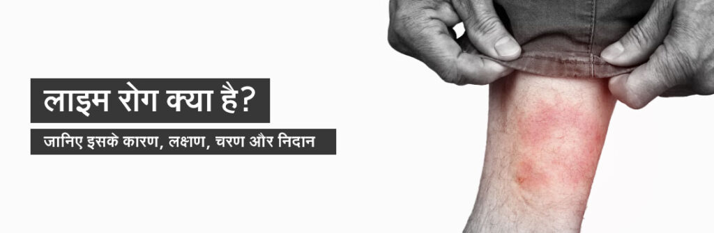 Lyme disease treatment in Hindi