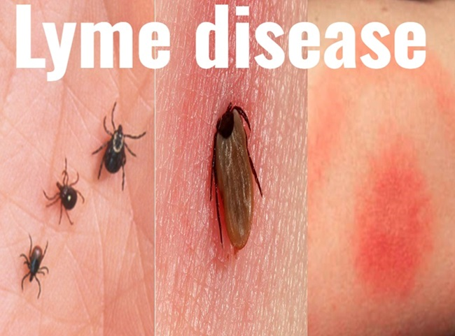 Lyme disease treatment in Hindi